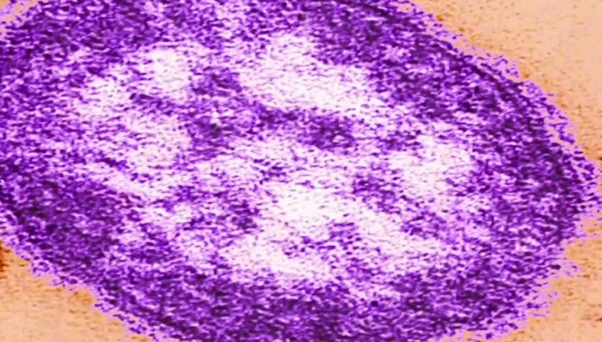 Virginia Health Department Investigates Measles Case in Harrisonburg