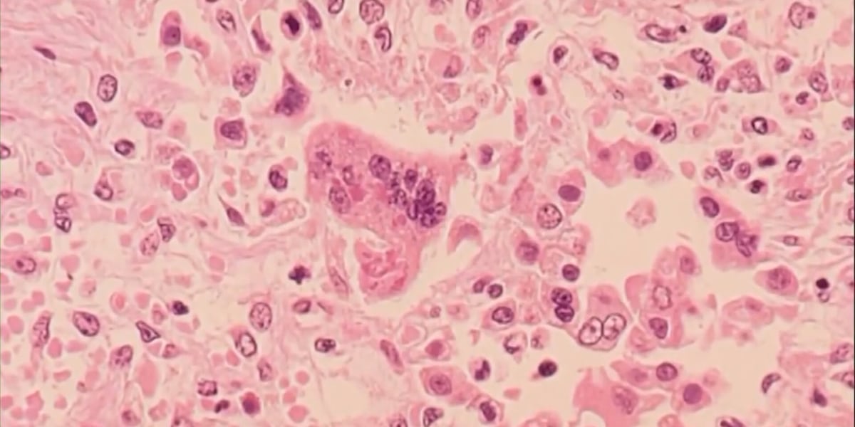 Measles Scare in Virginia: Second Case Confirmed in Teenager – Are You Protected?