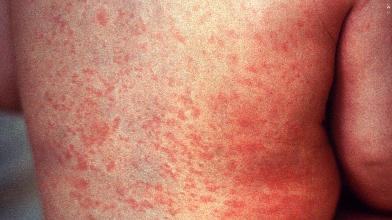 VDH confirms another measles case